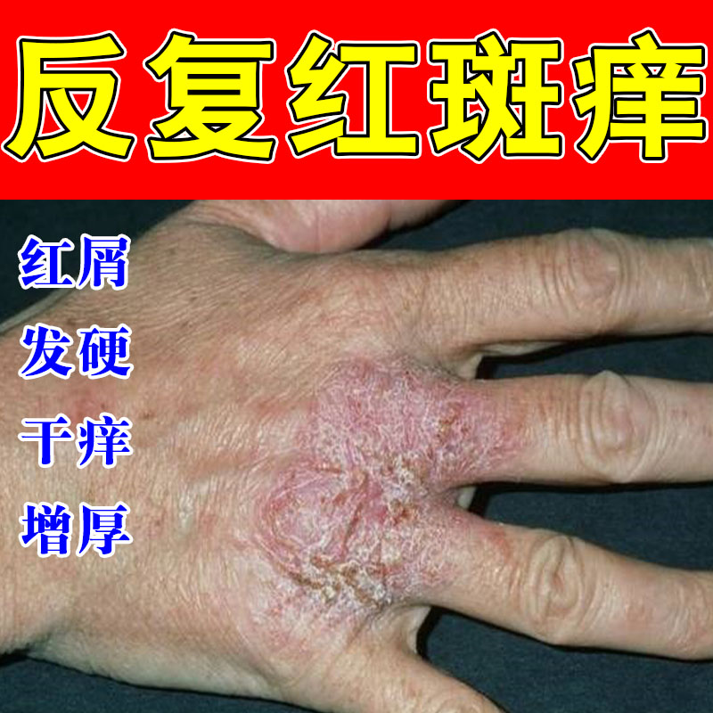 手部手指手背红斑硬疙瘩皮肤干燥起皮真菌脱屑舒缓草本修护乳膏