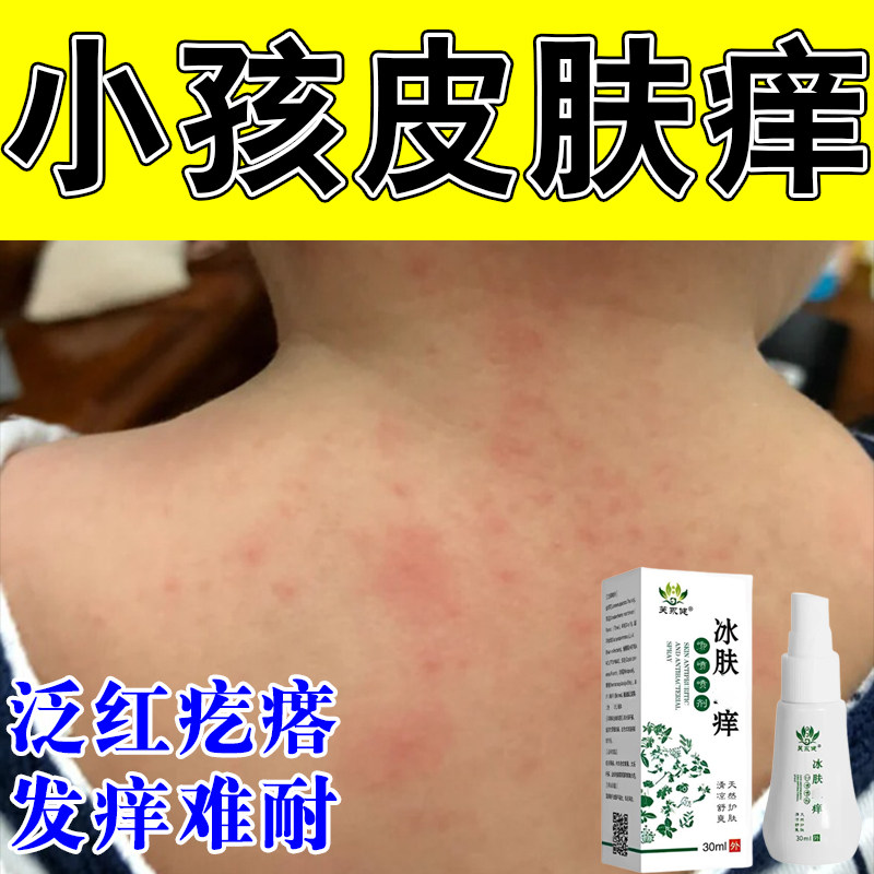 儿童身上红疙瘩草本蚊虫叮咬手臂小腿胳膊叮咬红肿起疙瘩痒喷剂