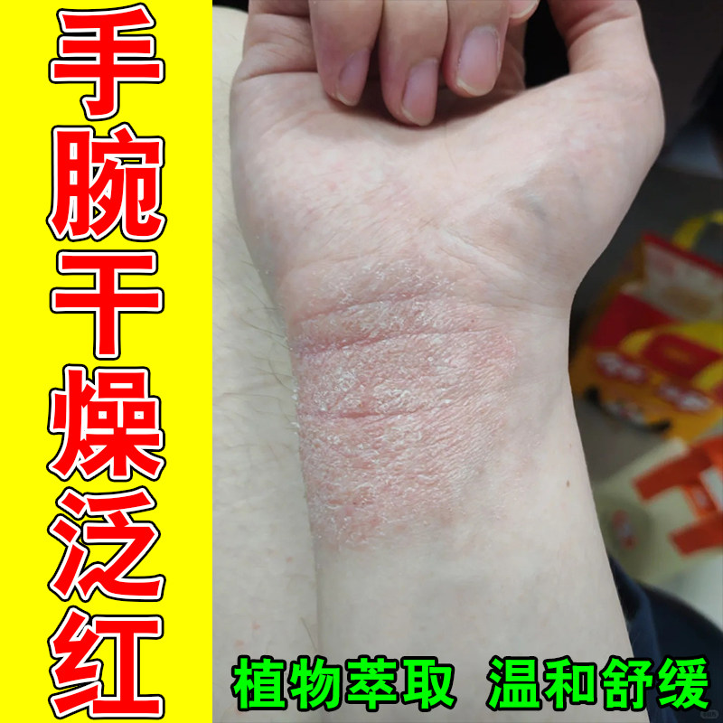 手上干燥起皮屑手腕关节泛红红肿发痒常年抓挠草本萃取舒缓膏