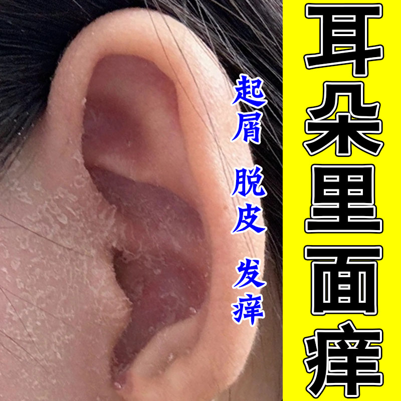冶耳朵痒起皮干燥起皮屑脱皮耳廓结痂草本修护膏