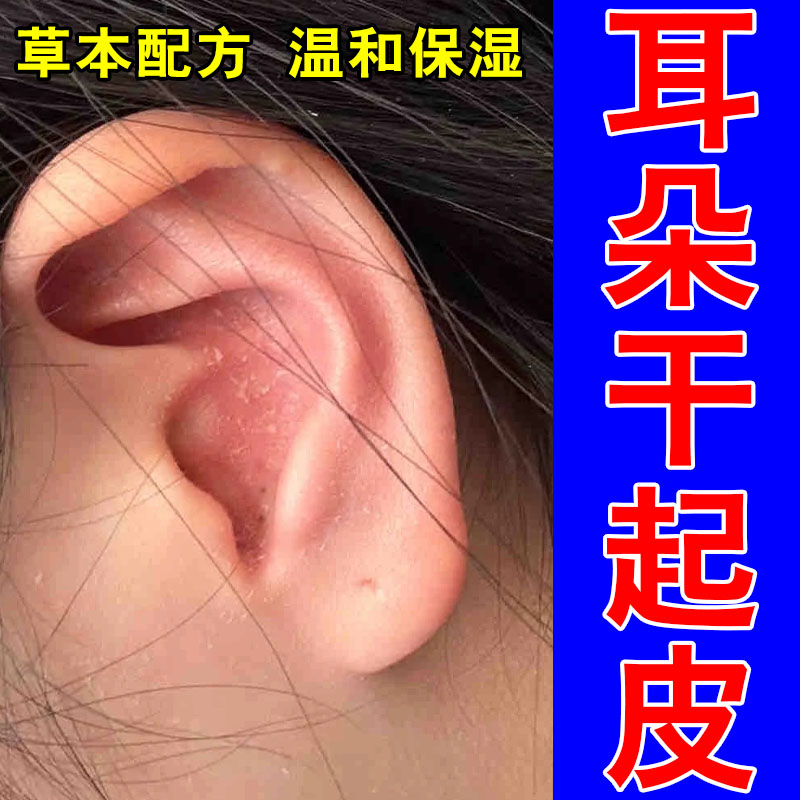 改善耳道干痒耳朵里面痒外耳道干燥脱皮掉屑结痂草本修护膏