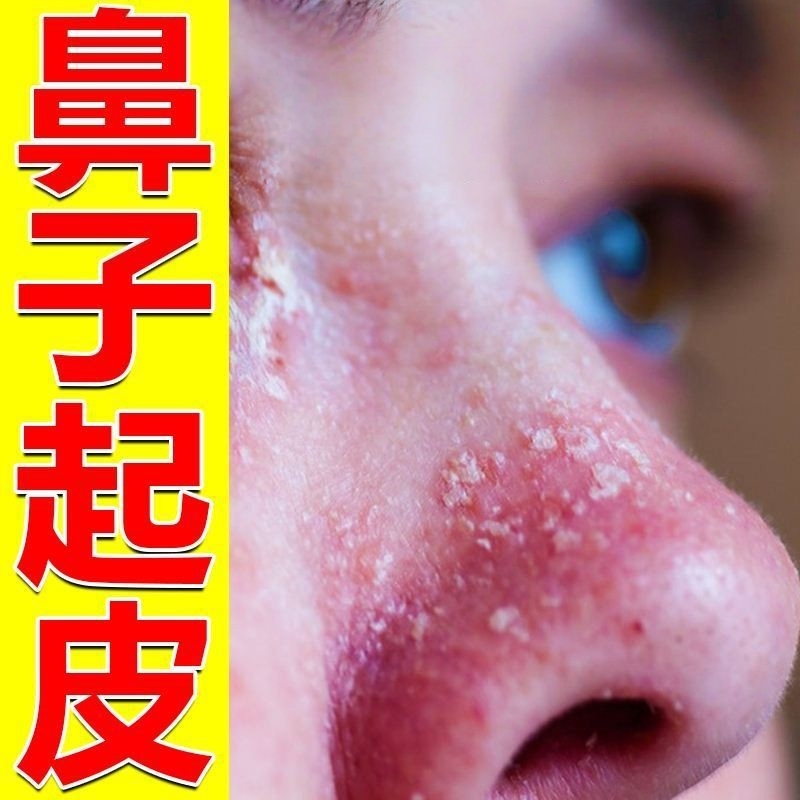 鼻翼两边发红脱屑专用修复鼻翼两侧泛红油腻刺痛酒糟鼻红鼻子干痒