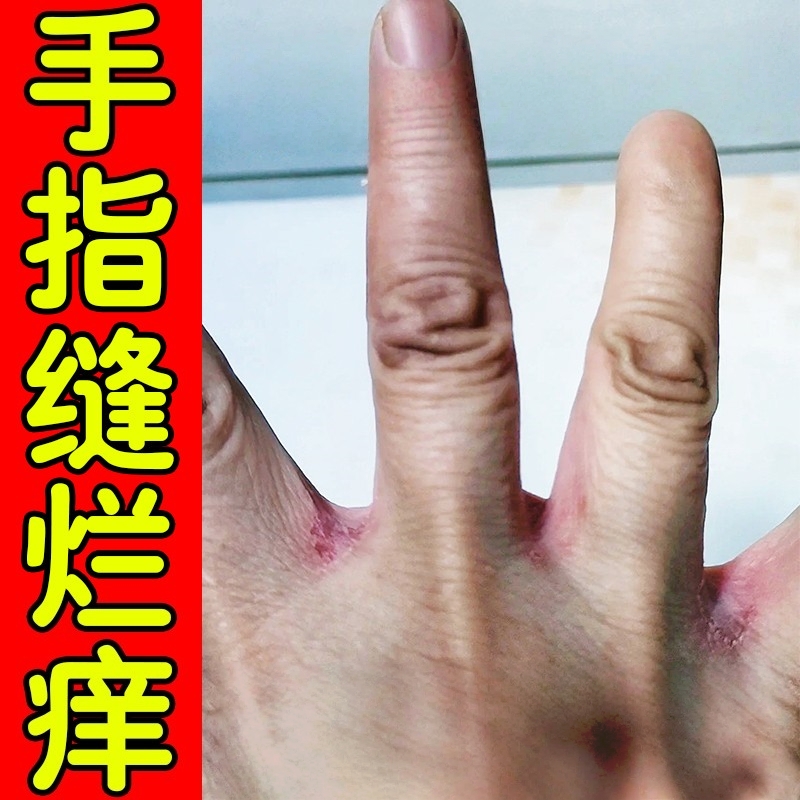 手指缝溃烂痒药膏手脱气皮瘙痒干燥烂手丫真菌感染糜烂手藓专用膏