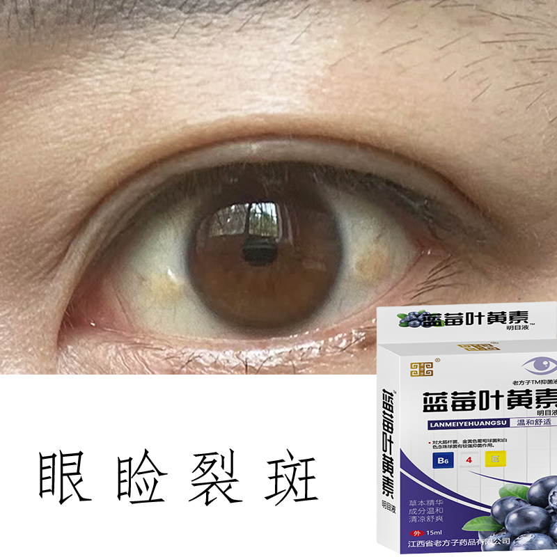 眼睑裂斑眼药水去除翼状胬肉消眼白发黄去黄玻璃球浑浊眼干红痒