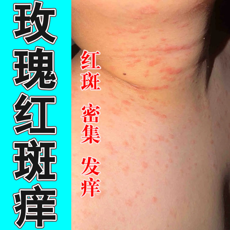 皮肤玫瑰红斑皮肤红斑起皮脖子过敏刺挠起皮粗糙干痒草本修护膏