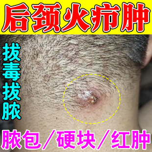 火疖子拔毒膏去皮下鼓包硬块皮脂腺囊肿痘痘黑点拔毒拔脓专用神器
