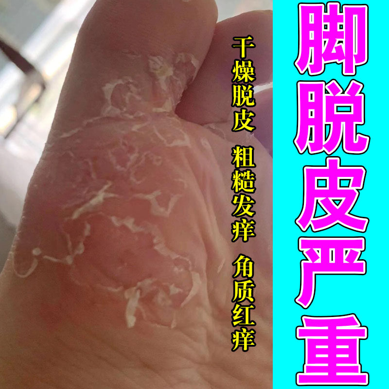 冶手脚脱皮脚底脱皮手足脱皮手脚粗糙掉皮反复脱皮草本修护软膏