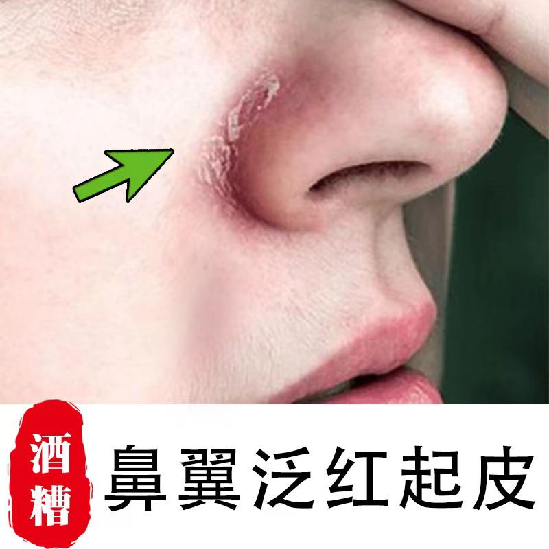 鼻子两侧发红脱皮鼻翼两边泛红血干燥起皮红鼻头治酒糟鼻专用膏药