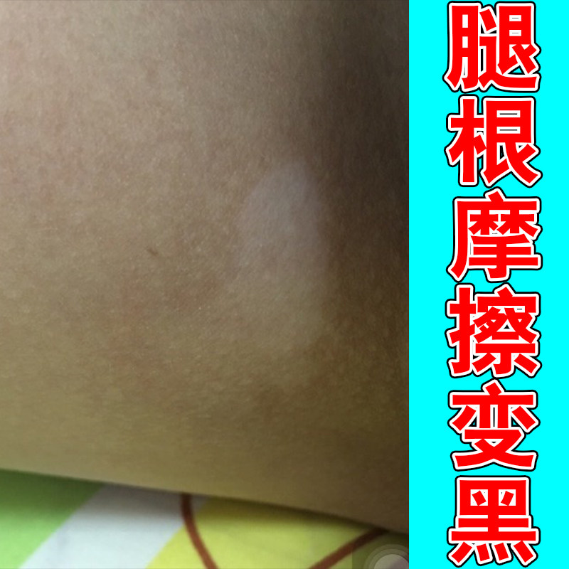 大腿内侧黑色素屁股摩擦发黑洗不干净通用黑斑修护按摩膏