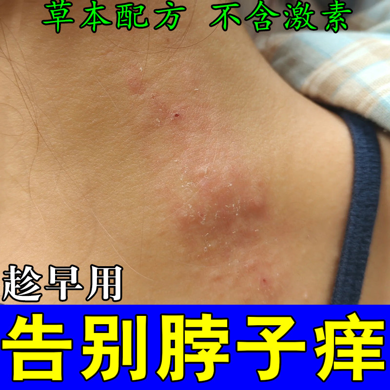 脖子干燥粗糙红疙瘩皮肤过敏红痒刺挠颈部红斑疙瘩顽固干痒膏乳