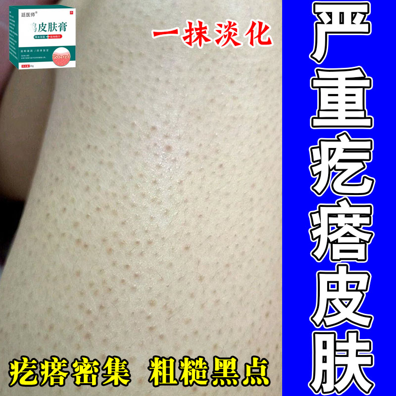 手臂鸡皮肤疙瘩起小颗粒胳膊毛囊长痘毛孔堵塞粗糙干燥修护皮肤霜