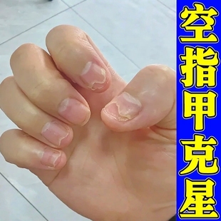 指甲空甲变空变白修复液凹凸不平发黄增厚甲床甲肉分离分层生长液
