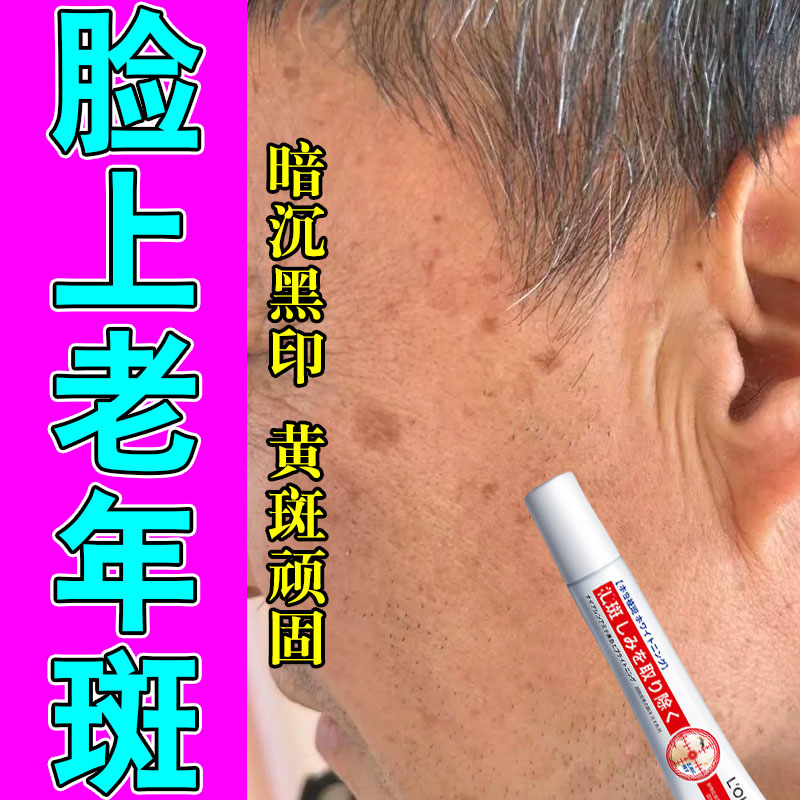 老年斑点黄色斑点脸部手部黄斑雀斑太阳斑修护保湿植物萃取膏