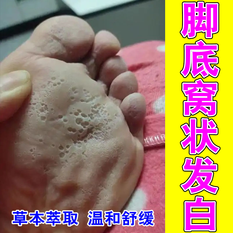 脚出汗脚汗窝状角质松解脚底发白蜂窝状沙虫草木修护膏