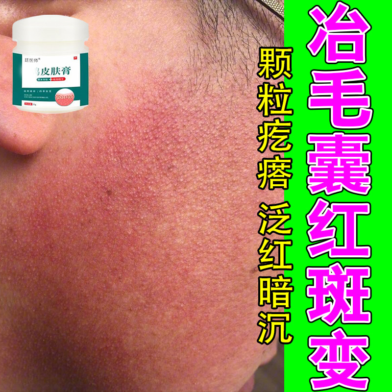 面部毛囊红斑黑变色素沉着粗糙起皮肌肤暗沉泛红粗糙草本修护膏