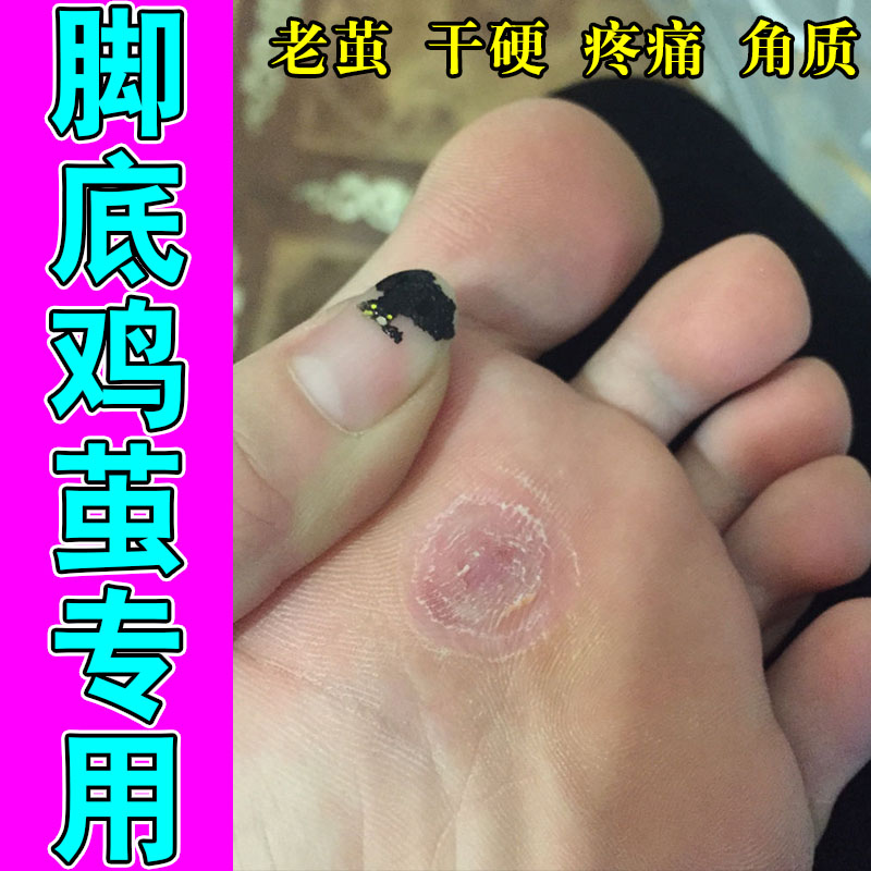 脚茧角质增厚脚底硬角质走路有异物感足部植物舒缓修护贴