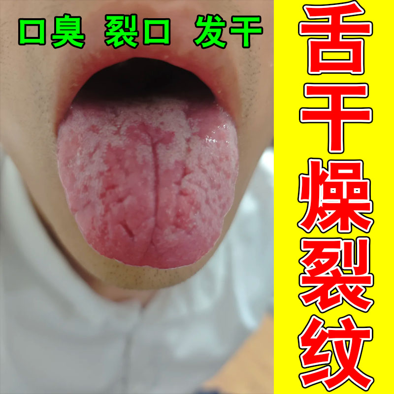 舌头裂纹沟纹舌苔厚白舌头开裂肿胀灼烧草本萃取温和喷剂
