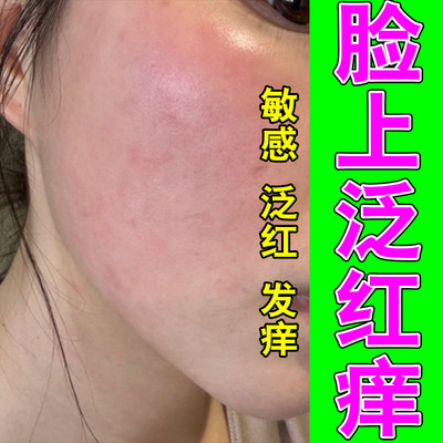 脸蛋敏感泛红发痒灼热起皮换季不适干疼植萃精华舒缓修护膏