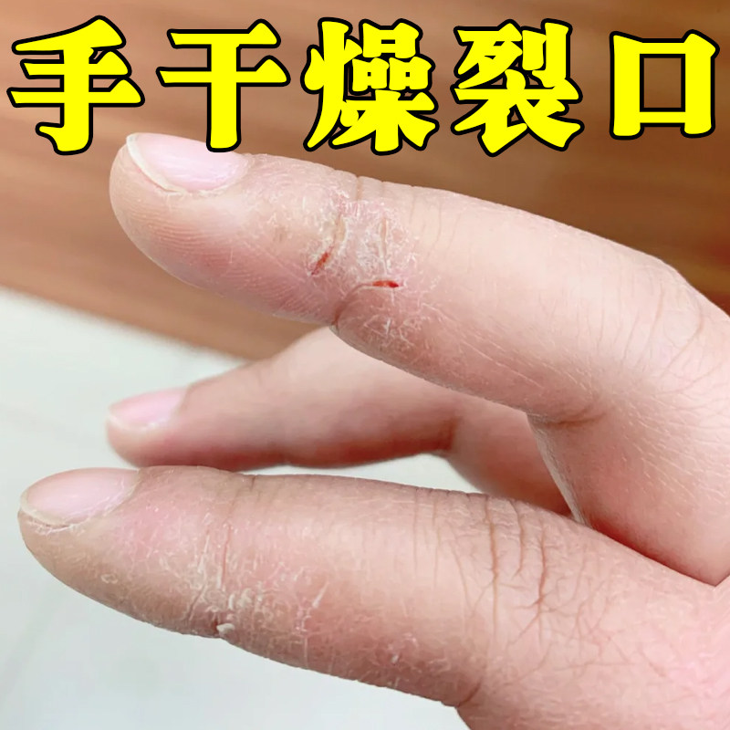 手干燥裂口子手指头开裂起硬皮手皮肤消毒护理（消）