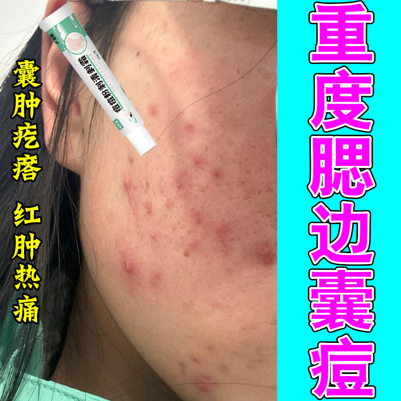 腮边淋巴痘改善反复硬块脓包红肿疙瘩疏通闭口粉刺草本舒缓乳膏