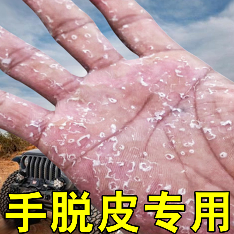 手指起皮干裂严重手指头脱皮药手掌蜕皮痒真菌感染干燥粗糙起皮膏