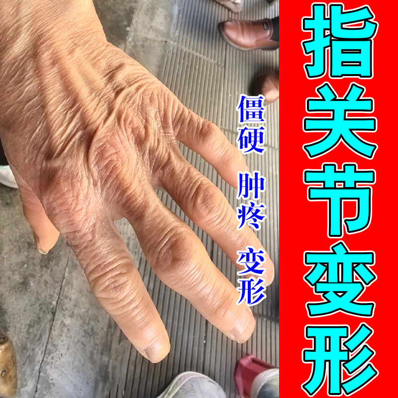 手指关节僵硬肿痛草本膏老人手指粗大弯曲费劲日常关节草本软膏