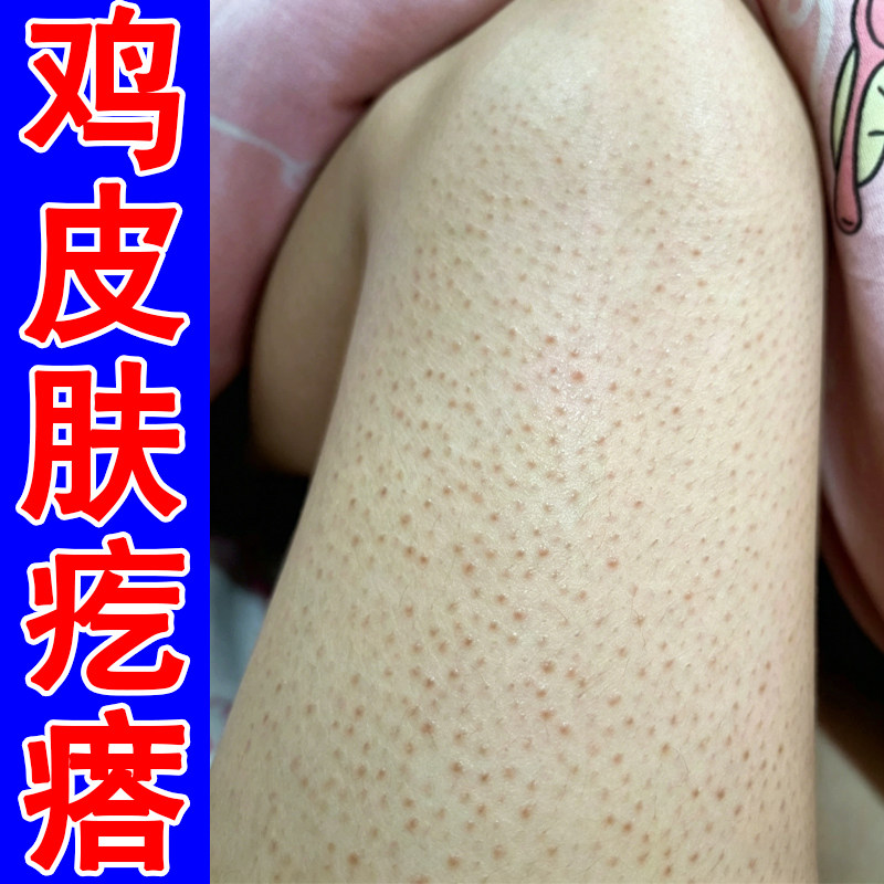 鸡皮疙瘩腿上黑点摸起来很粗糙干燥修复毛囊堵塞毛周角化症专用膏