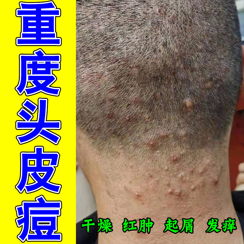 头皮长痘毛囊疙瘩冶头部后脑勺起硬块疙瘩疼红结痂红肿草本软膏