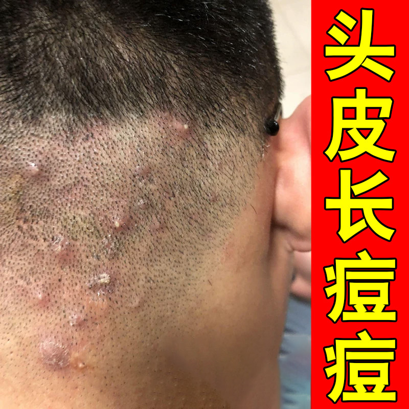 头皮长痘痘药毛囊头部皮肤痒长疙瘩有脓包毛囊堵塞痒外用修复乳膏