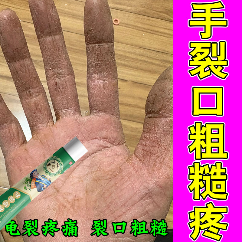 冶手干裂脱皮季节性手掌手指干裂脚上起皮掉皮脱屑干痒严重专用膏