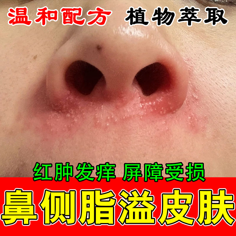 脂溢性鼻侧发红起皮鼻翼两边泛红干燥起皮发痒萃取草本修复软膏