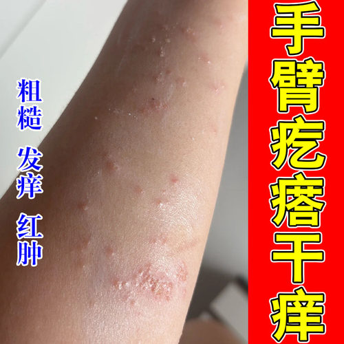 皮肤过敏干燥起红疙瘩红点粗糙红肿掉屑舒缓换季肌肤外用修护膏