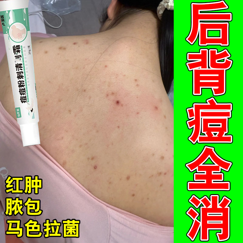 后背长痘身上后背红肿脓包疙瘩马拉色菌疙瘩红肿痒密集修护植物膏