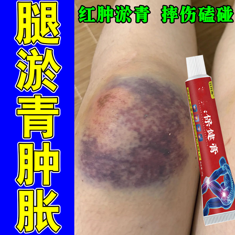 腿上淤青活血化瘀去膝盖摔磕撞伤发紫跌打损伤淤青专用软膏