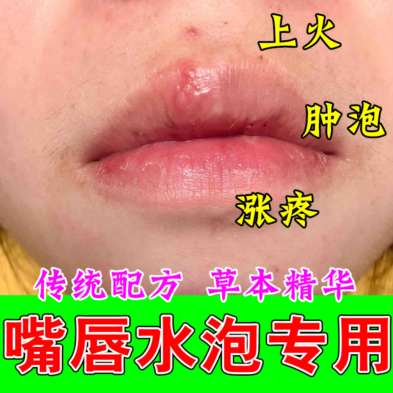 口角上火嘴角膏药冶疗上火干燥感染冶疗脱皮起水泡疼唇膏润唇膏