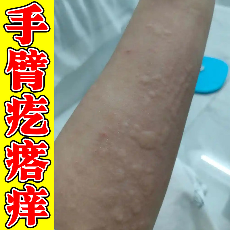手臂疙瘩痒长小点痒胳膊小腿痒身上痒起疙瘩外用膏
