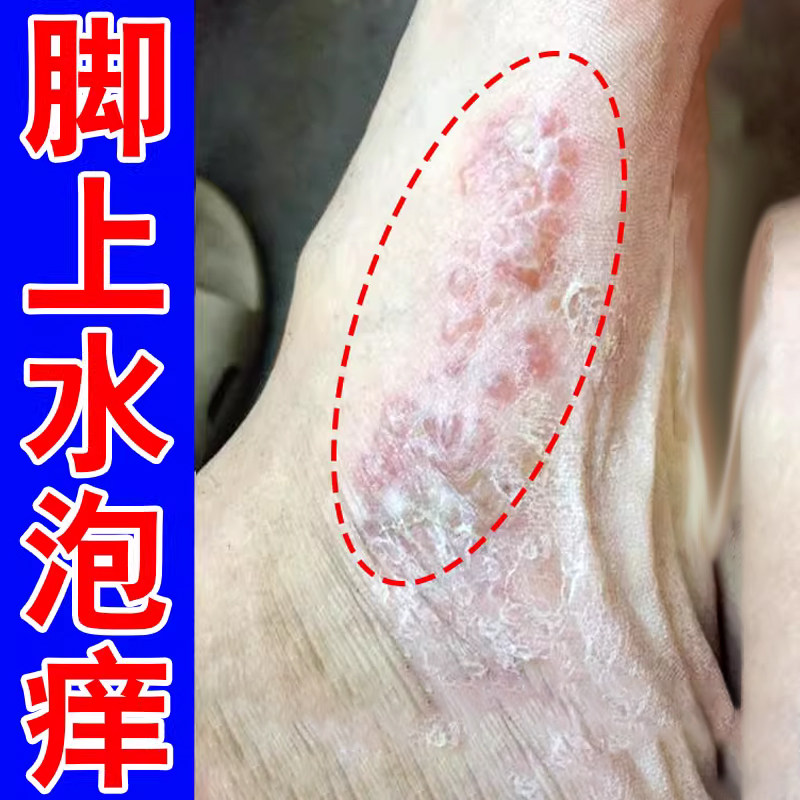 脚底上起小水泡又痒又脱皮脚痒掉皮脚丫痒脚脱皮痒喷雾