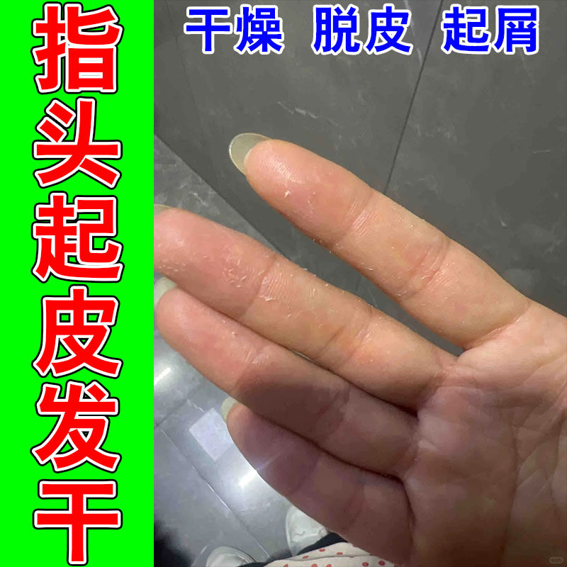 手掌心干燥脱皮粗糙手干燥蜕皮起皮屑发痒专用保湿草本乳膏