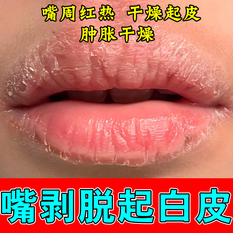 口角嘴角膏乳冶上火开裂真菌起皮疙瘩冶脱皮专用草本乳膏