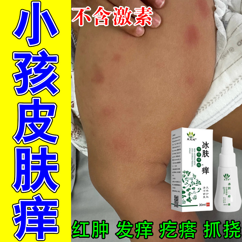 孩子身上疙瘩痒蚊虫叮咬小虫咬皮肤过敏丘疙瘩红肿草本用修护喷剂