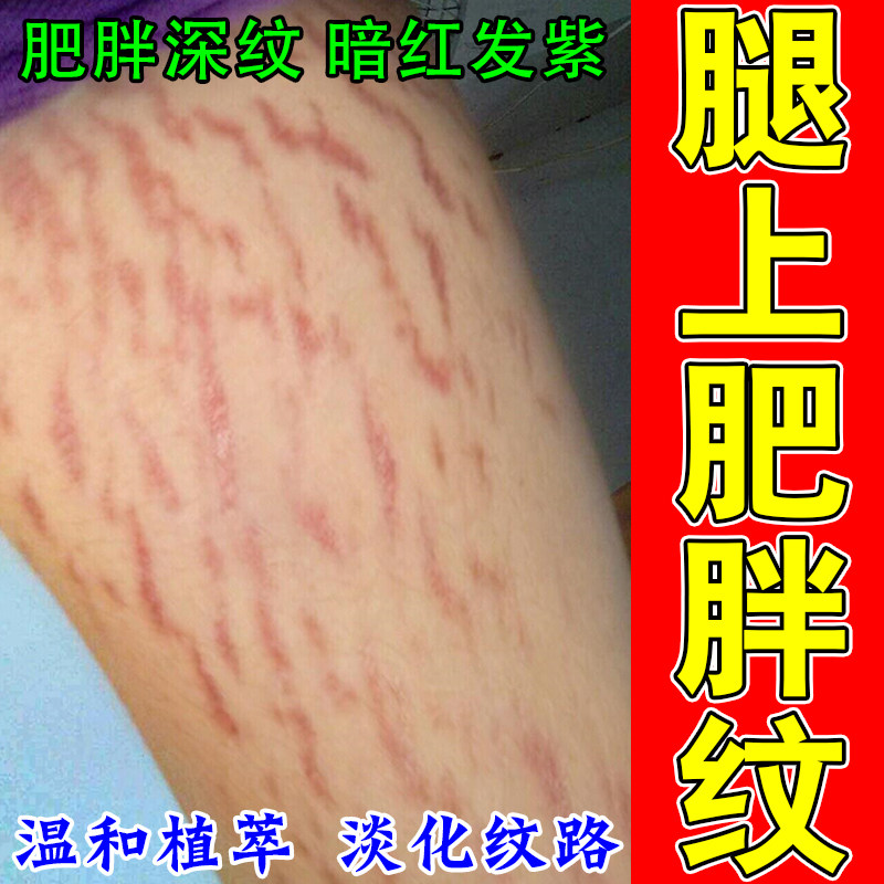去肥胖纹生长纹修复霜消大腿学生腿上腰腹上肥胖纹男女通用膏