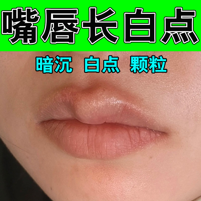 皮脂腺异位治嘴唇白点脂肪小颗粒增生嘴巴泡起皮白点草本修护软膏