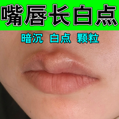 皮脂腺异位治嘴唇白点脂肪小颗粒增生嘴巴泡起皮白点草本修护软膏