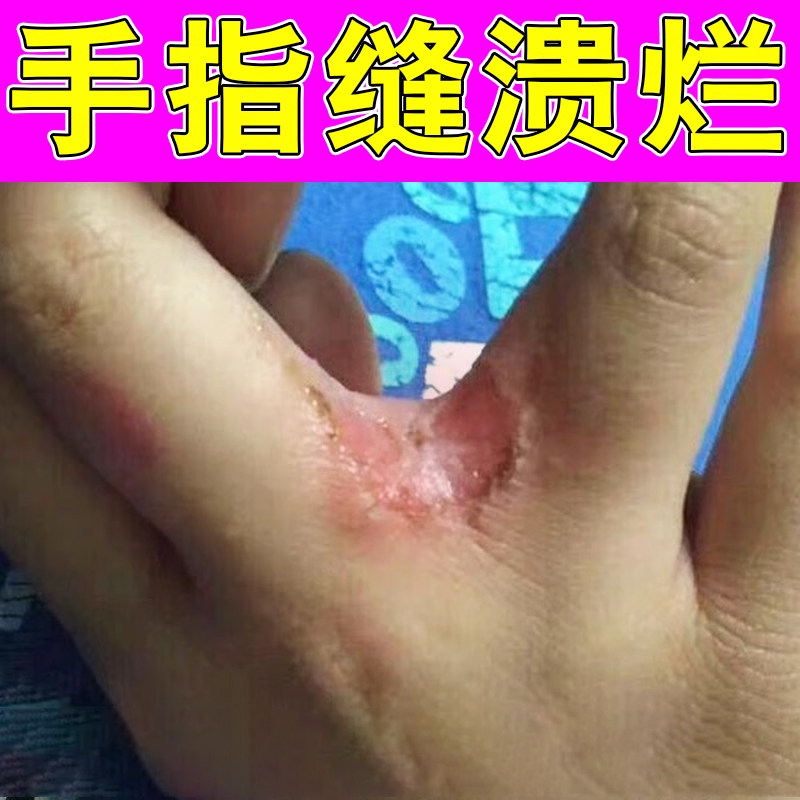 手指缝溃烂药烂手丫起水泡糜烂疼痛痒潮湿红肿掉皮起皮脱皮痒软膏