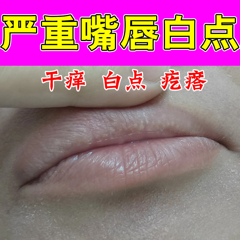皮脂腺异位嘴唇上长小白点脂肪小颗粒嘴巴干裂起皮疼痛草本保湿膏