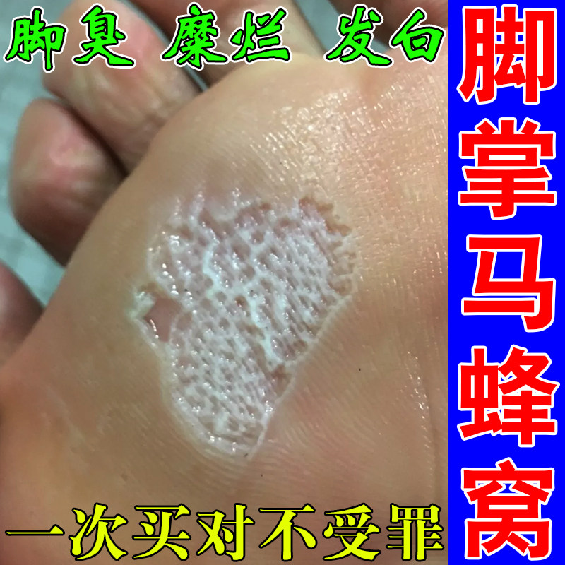 窝状角质松解症脚底起泡蜂窝状脚脚蜕皮专用膏