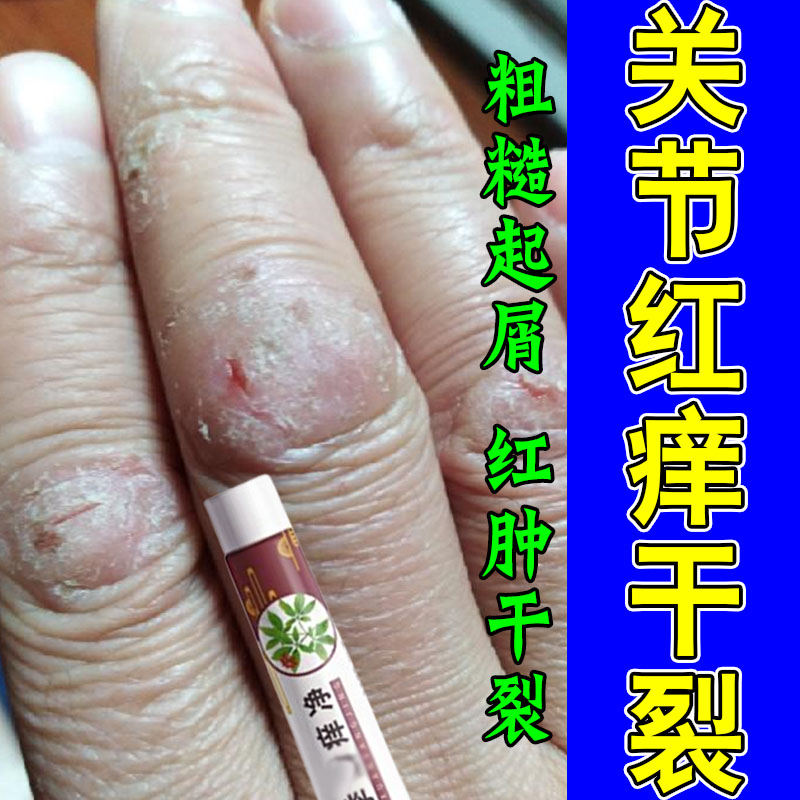 手指关节真菌手指关节长硬疙瘩伤粗糙脱皮手痒真硬块粗糙痒修护膏