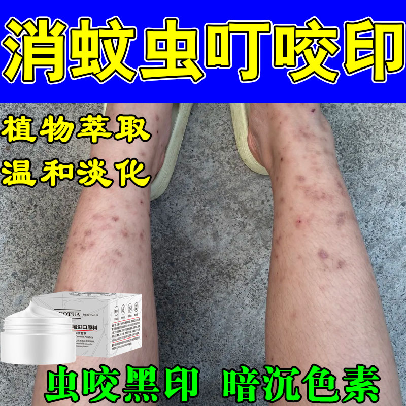 冶蚊虫叮咬疤痕黑印明显疤印深色黑色素沉淀积雪草修复按摩膏