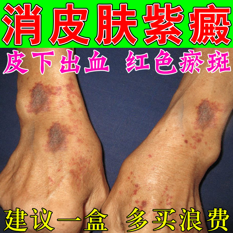 紫癜手部色素沉淀冶疗紫斑皮下出血长小红点淤血老年性紫癜药软膏