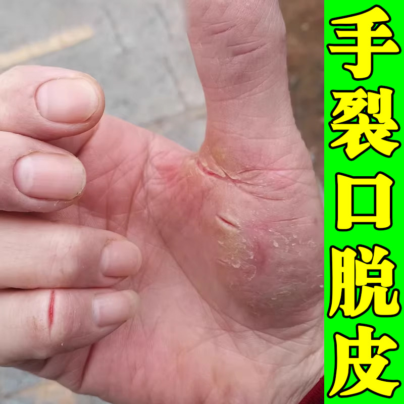 手干裂脱皮真菌蜕皮手干燥粗糙手皮肤消毒护理（消）